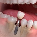 implantes dentales reus