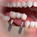 implantes dentales reus